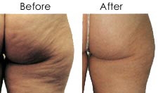 Endermologie