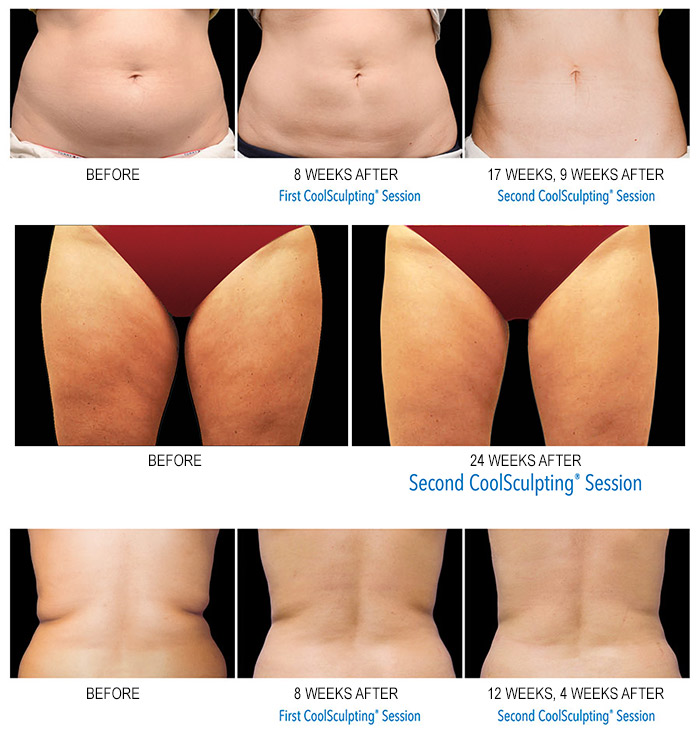 CoolSculpting Before and After Images