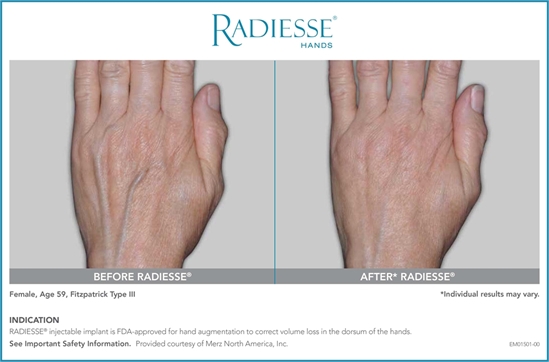 Radiesse for hands