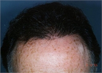 Hair Transplant New York City Westchester County