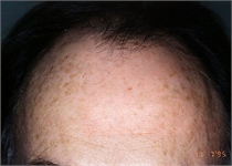 Hair Transplant New York City Westchester County