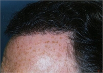 Hair Loss New York City Westchester County