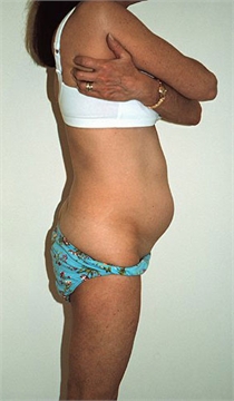 Tumescent Liposuction New York City Westchester County