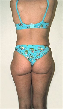 Tumescent Liposuction New York City Westchester County