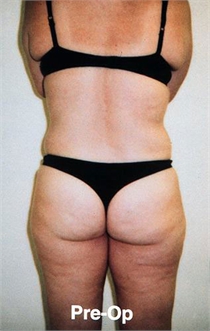 Tumescent Liposuction New York City Westchester County