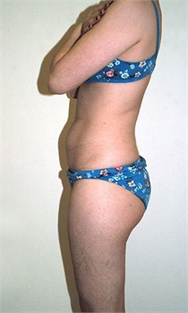 Tumescent Liposuction New York City Westchester County