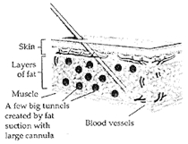 liposuction new york city