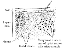 Tumescent liposuction