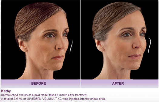 Juvederm New York