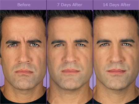 botox for men