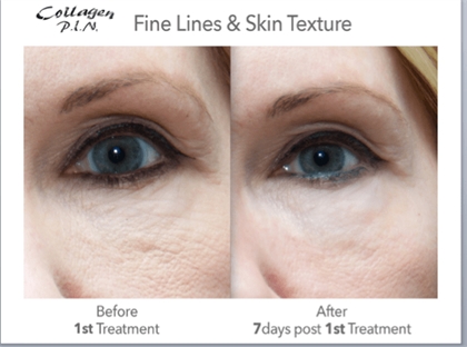 Fine Lines and Wrinkles Before and After