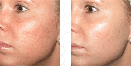 Fine Lines and Wrinkles Before and After