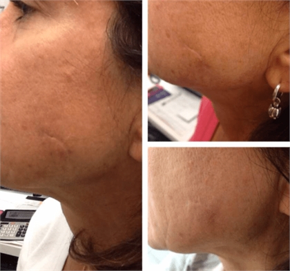Acne and Acne Scarring Before and After