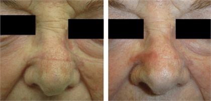 Microneedling Westchester Before and After