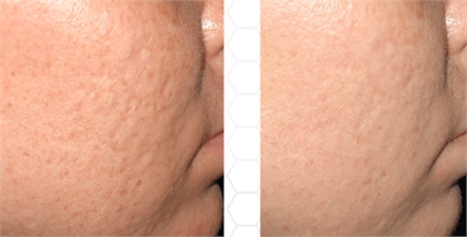 Microneedling Westchester Before and After