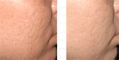 Acne and Acne Scarring Before and After