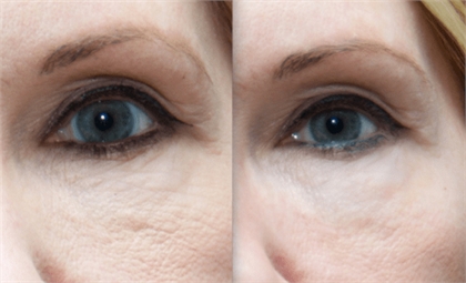 Microneedling Westchester Before and After