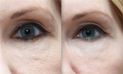 Fine Lines and Wrinkles Before and After