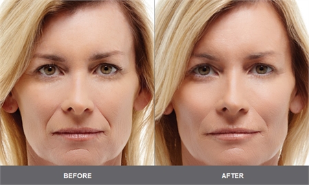 Radiesse before and after